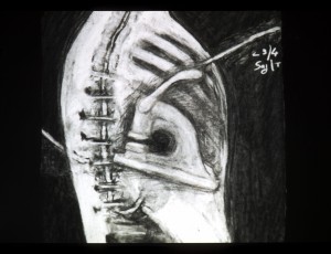 <div class="lightbox-artworktitle">History of the Main Complaint</div><div class="lightbox-artworkyear">1996</div><div class="lightbox-artworkdescription">35 mm animated film, transferred to video and DVD</div><div class="lightbox-artworkdimension">5 min 50 sec</div><div class="lightbox-artworkdimension">Edition of 10</div><div class="lightbox-tagswithlinks"><A rel='nofollow' href='/page/1/?s=%23Charcoal'>#Charcoal</A> <A rel='nofollow' href='/page/1/?s=%23Soho'>#Soho</A> <A rel='nofollow' href='/page/1/?s=%23Series'>#Series</A> <A rel='nofollow' href='/page/1/?s=%23Edition'>#Edition</A> <A rel='nofollow' href='/page/1/?s=%23SingleChannel'>#SingleChannel</A> <A rel='nofollow' href='/page/1/?s=%23Animation'>#Animation</A> <A rel='nofollow' href='/page/1/?s=%23DrawingsForProjection'>#DrawingsForProjection</A></div>